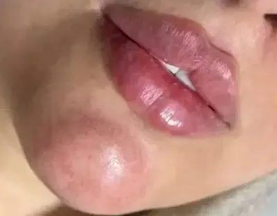 تزریق فیلر زیر چشم بینی لب در اصفهان 