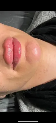 تزریق فیلر زیر چشم بینی لب در اصفهان 