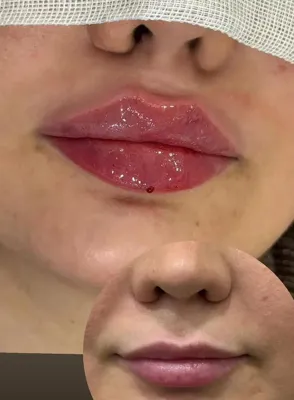 تزریق فیلر زیر چشم بینی لب در اصفهان 