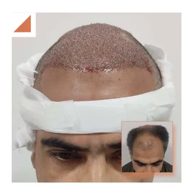 کاشت مو در دزفول