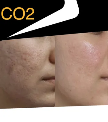 رفع جای جوش در بهترین کلینیک زیبایی دزفول