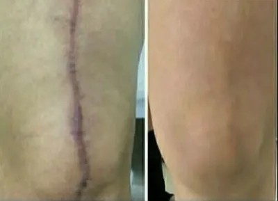 رفع جای زخم و بخیه در بهترین کلینیک زیبایی دزفول