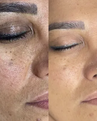 رفع لک و روشن سازی پوست در بهترین کلینیک زیبایی دزفول