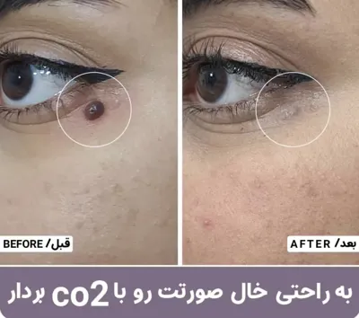 برداشتن خال صورت در بهترین کلینیک زیبایی دزفول
