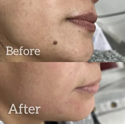 برداشتن خال در بهترین کلینیک زیبایی دزفول