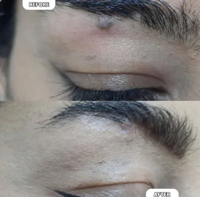 برداشتن خال در بهترین کلینیک زیبایی دزفول