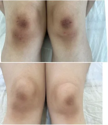 روشن سازی زانو در بهترین کلینیک زیبایی دزفول