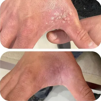 کرایو زگیل در بهترین کلینیک زیبایی دزفول