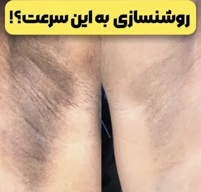 روشن سازی بدن با لیزرco2 در بهترین کلینیک زیبایی دزفول