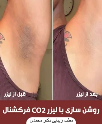 روشن سازی پوست در بهترین کلینیک زیبایی دزفول