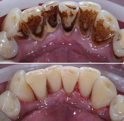خدمات جرم گیری دندان در کرج