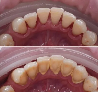 جرم گیری دندان در کرج