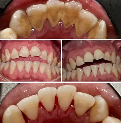 جرم گیری دندان در کرج