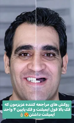 ایمپلنت در افسریه