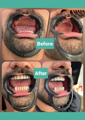 ایمپلنت افسریه