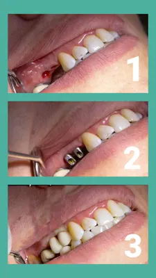 خدمات ایمپلنت در افسریه