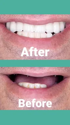 ایمپلنت قسطی در افسریه