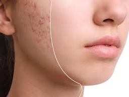 رفع جای جوش در سنندج