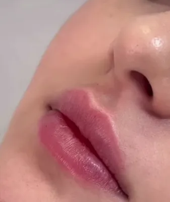 فیلر لب در سنندج