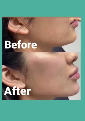 ساکشن غبغب در سنندج