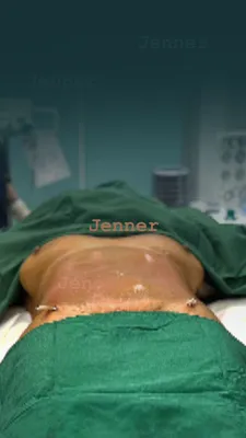 لیفوساکشن شکم در کرج