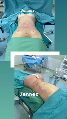 لیپوساکشن در کرج