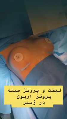 لیپوساکشن حرفه‌ای در کرج