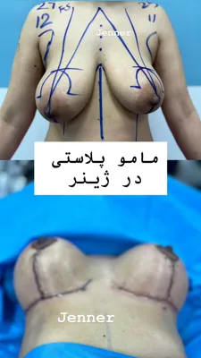 لیپوپلاستی در کرج