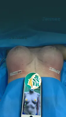 لیپوساکشن ارزان در کرج