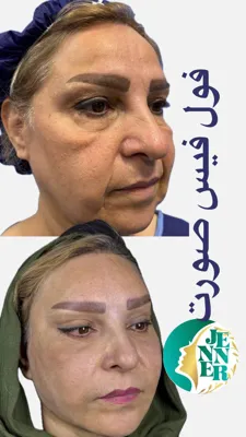 لیپوساکشن با قیمت مناسب در کرج