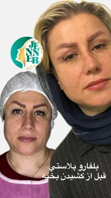 لیپوساکشن در کلینیک ژینر