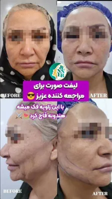 لیپوساکشن با قیمت مناسب در کرج