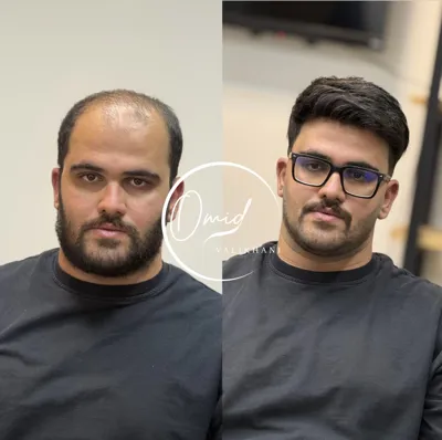 پروتز مو دولت آباد