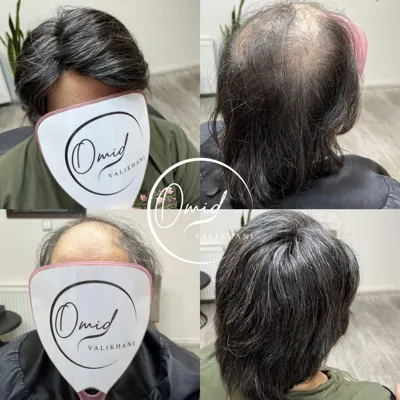 پروتز مو شهرکرد