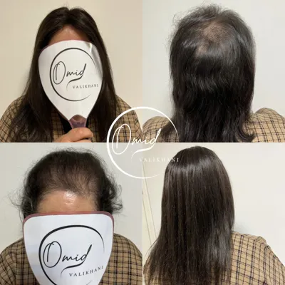 پروتز مو شهرکرد