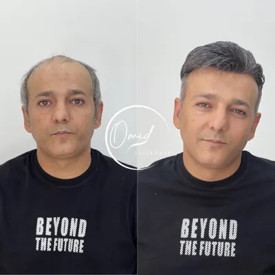 پروتز مو سمیرم