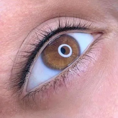 میکروبلیدینگ در شمال تهران