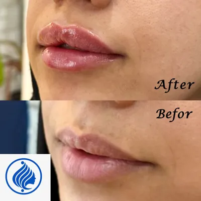 تزریق فیلر لب
