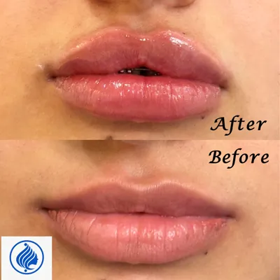 تزریق فیلر لب کلینیک باران