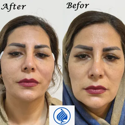 لیفت با نخ&nbsp;