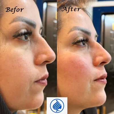 تزریق فیلر چانه و گونه