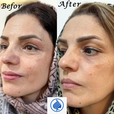 تزریق فیلر زیر چشم&nbsp;