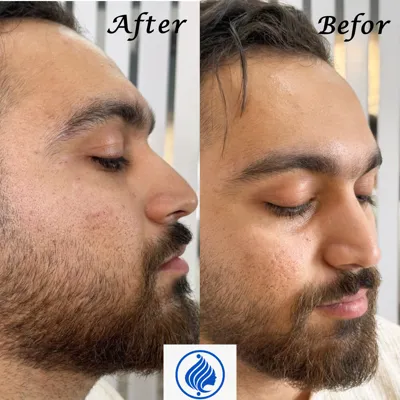 فیلر دور چشم