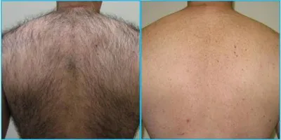 لیزر آقایان در بروجرد