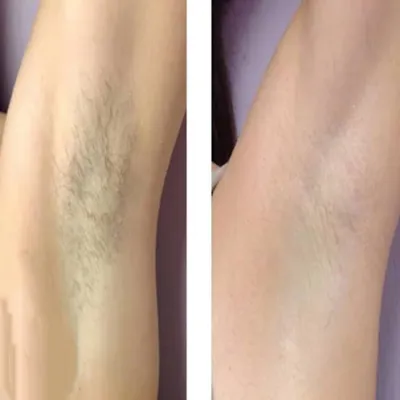 لیزر موی زائد در بروجرد