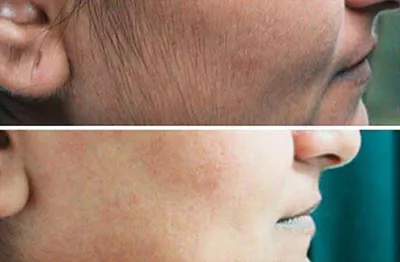 لیزر صورت در بروجرد