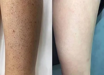 لیزر بروجرد