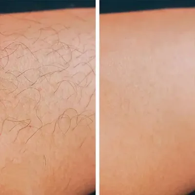 خدمات لیزر در بروجرد