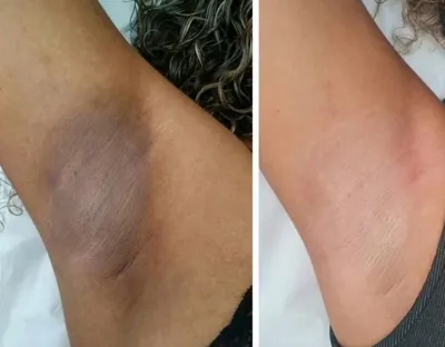 لیزر مو در بروجرد