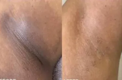 لیزر کربن تراپی در بروجرد